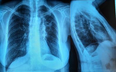 Case Report: Allergic Bronchopulmonary Aspergillosis Revealing Asthma